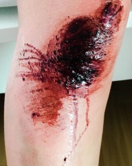 Bloody knee #bloodyknees #worserphoto #summerblisters #bloody #awesome shots